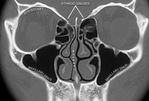 This image has an empty alt attribute; its file name is CT_scan_image_of_sinuses.jpg