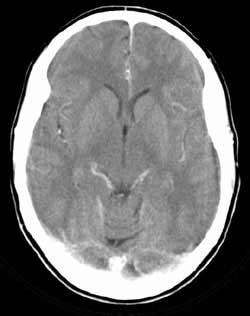 CT scan of a brain
