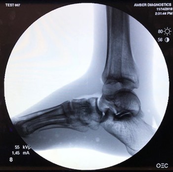 Image obtained with the GE OEC 9800 C-Arm machine flat panel digital detector upgrade.