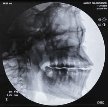 Image obtained with the GE OEC 9800 C-Arm machine flat panel digital detector upgrade.
