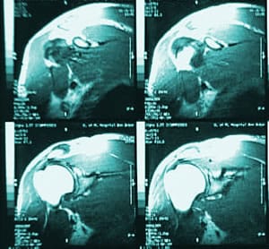 MRI scans of shoulder 