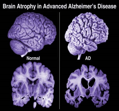Alzheimers-Disease-and-Imaging2