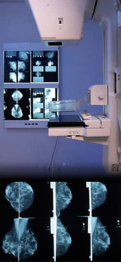 Mammography-Procedure2