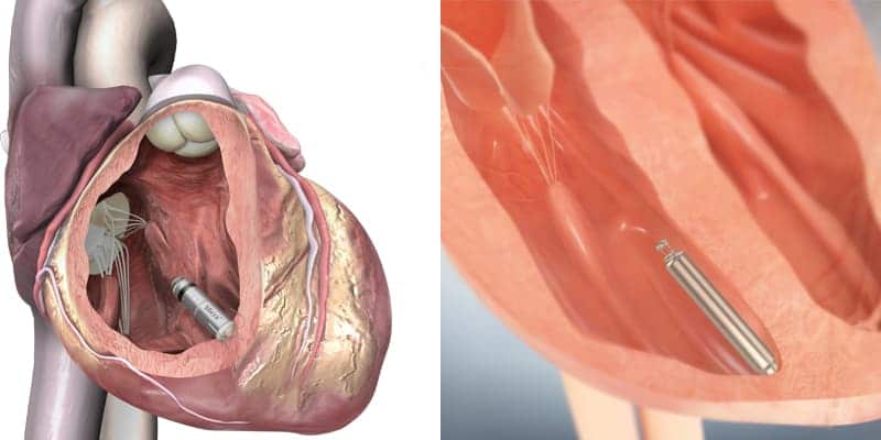 leadless pacemaker