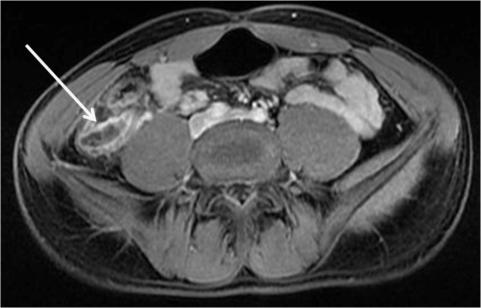 Perforated appendicitis axial lavaflex mr