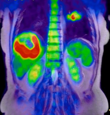 Liver tumor image taken with Philips Ingenuity PET/CT