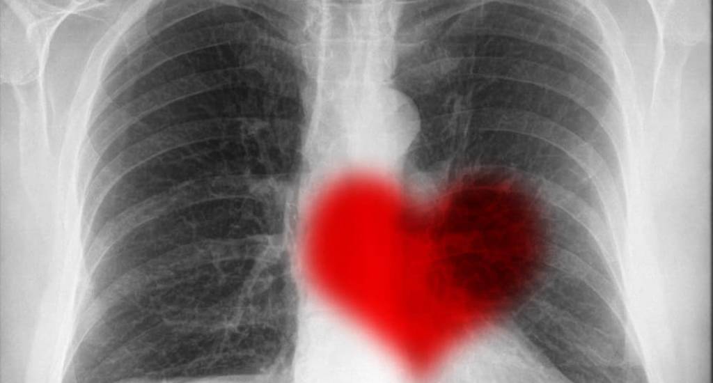 Radiology Heart