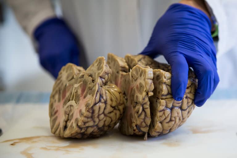 Dr. Ann McKee working on a brain specimen in her lab.