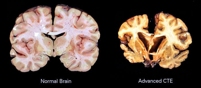 Normal Vs. Advance CTE brain