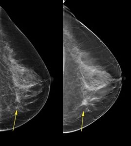 Mammograph Image