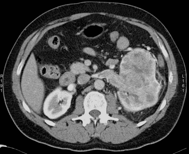 MRI Scan