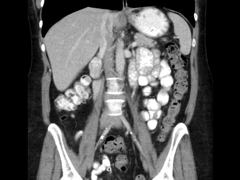 CT Scan