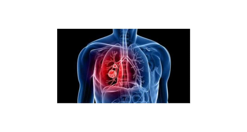 Easing the pain of lung cancer