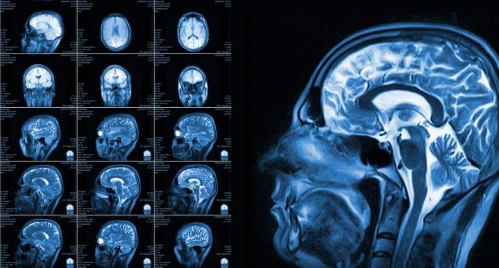 Imaging iron content with MRI technique can show impact of stroke