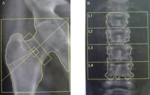 Dexa Scan