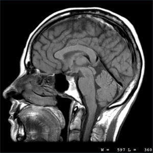 mri of the brain