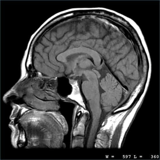 mri of the brain