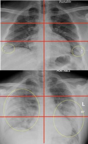 chest x-ray showing covid 19 in lungs