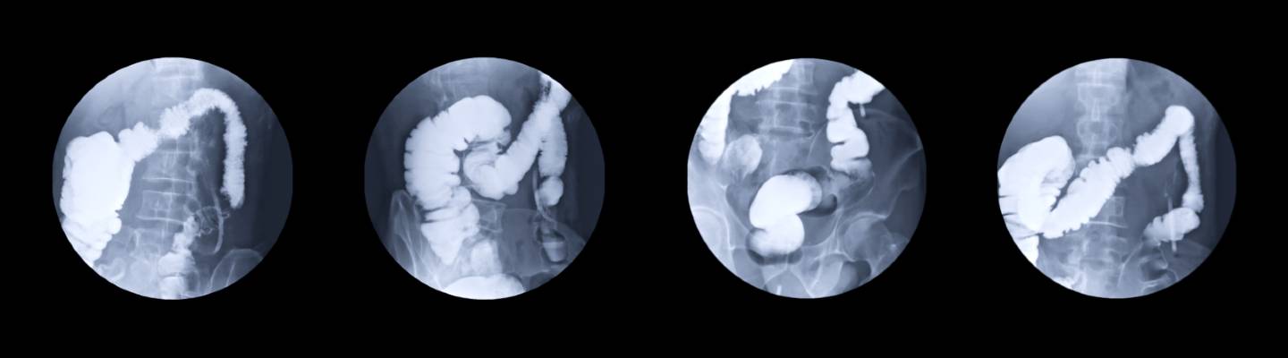 Fluoroscopy image acquisition on a C-arm