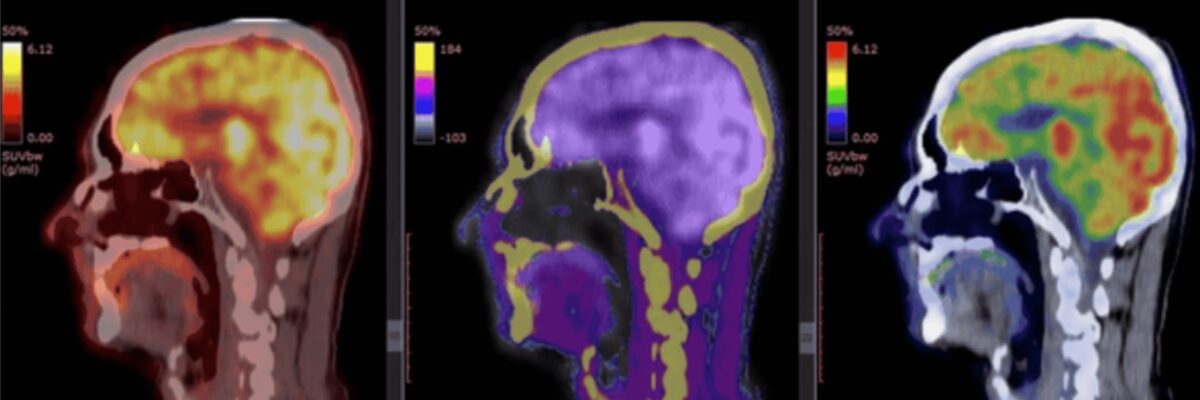 PET brain scan images showing metabolic activity alongside CT anatomy